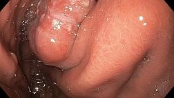 Эндоскопическая подслизистая диссекция аденокарциномы пищеводно-желудочного перехода у пациента после комплексного лечения первичной лимфомы головного мозга. Клинический случай